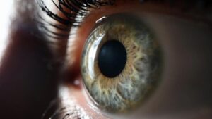 GLAUCOMA